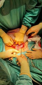 Asportata enorme cisti ovarica presso la Struttura di Ginecologia ospedaliera del Policlinico Riuniti di Foggia